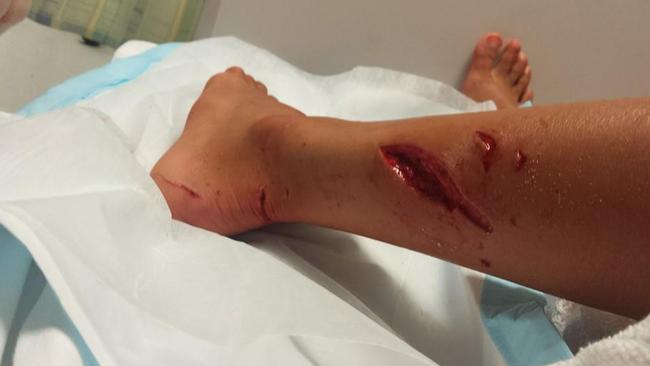 Facebook image of Kirra-belle Olsson after she was attacked by a shark at Avoca Beach.