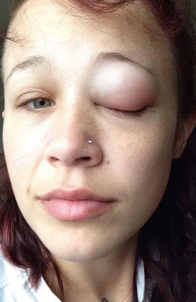 Catt Gallinger eye tattoo gone wrong. Picture: Facebook