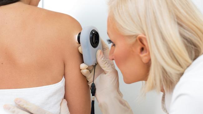 Queensland researchers have made a major melanoma breakthrough. (File picture)