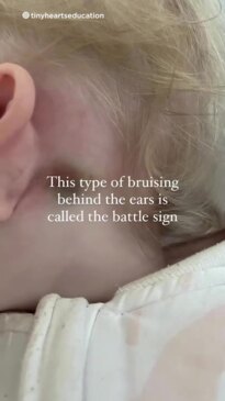 The bruise no parent should ignore