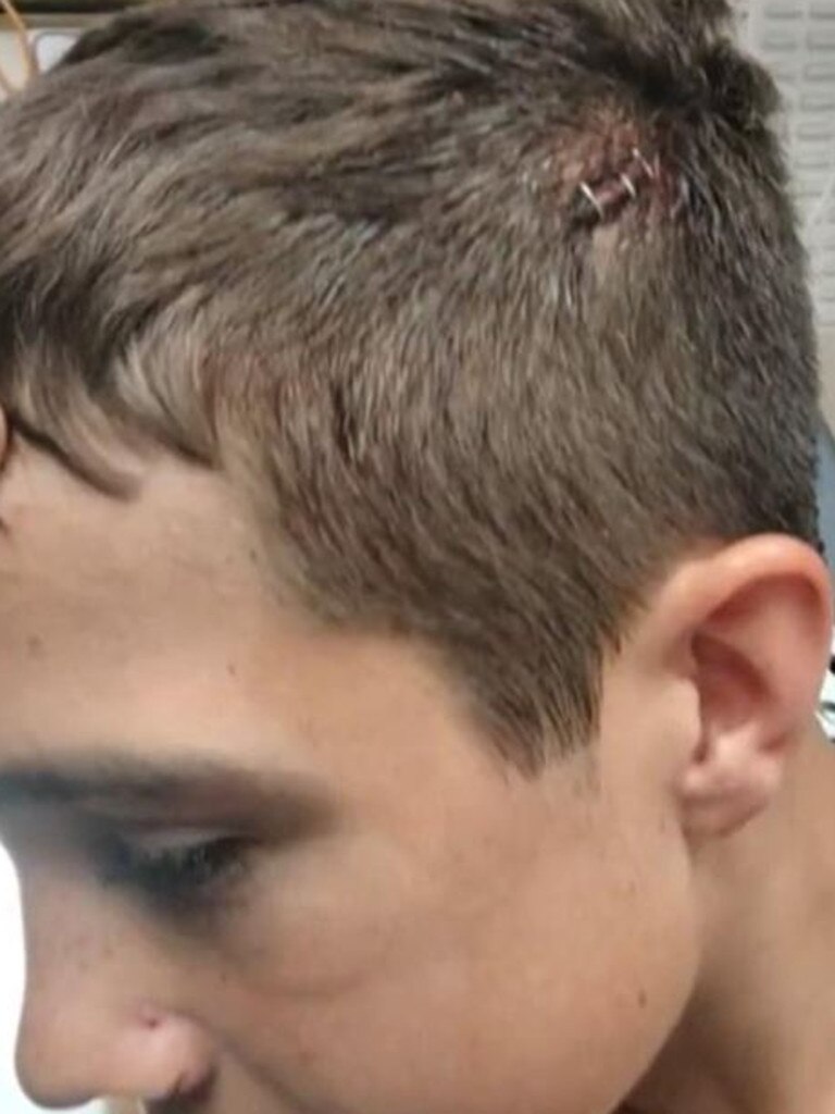 The 13-year-old needed staples in his head. Picture: Facebook