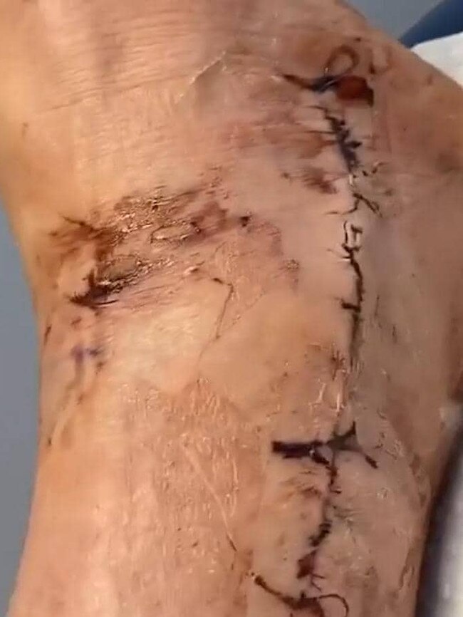 The star Swan posted this picture of his ankle after surgery.