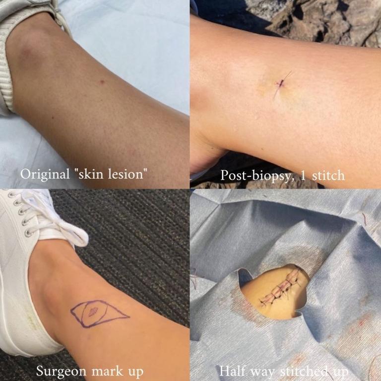 She shared photos of her freckle during the process of having it removed. Picture: Instagram/OceanaStrachan