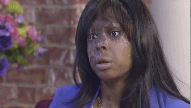 Arrests Made In Uk Acid Attack Which Severely Scarred London Woman Naomi Oni Au 9119