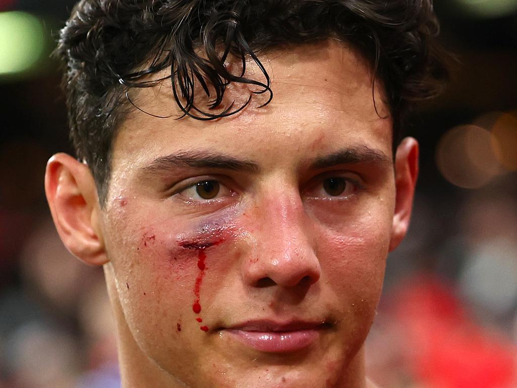 The tough midfielder copped a shiner. Picture: Quinn Rooney/Getty Images