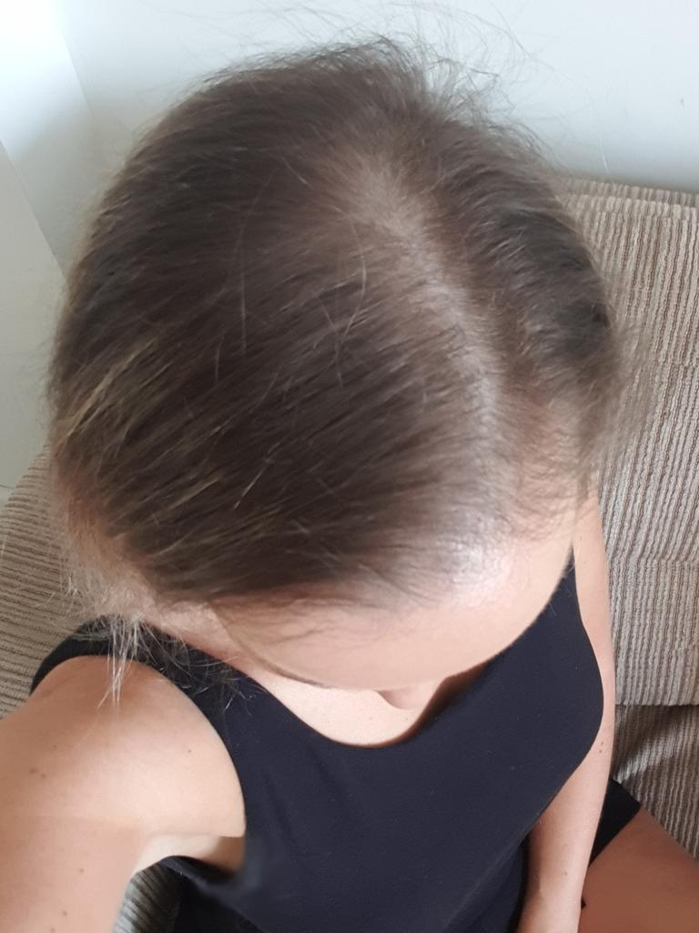 Alopecia Woman Shares Amazing Hair Loss Journey On Instagram Herald Sun