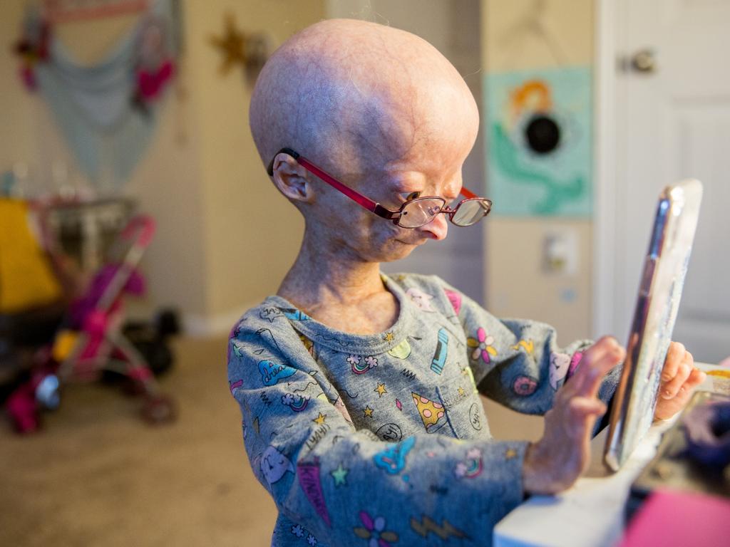 Adalia Rose 11yo Girl With Rare Aging Condition Goes Viral On Youtube Daily Telegraph
