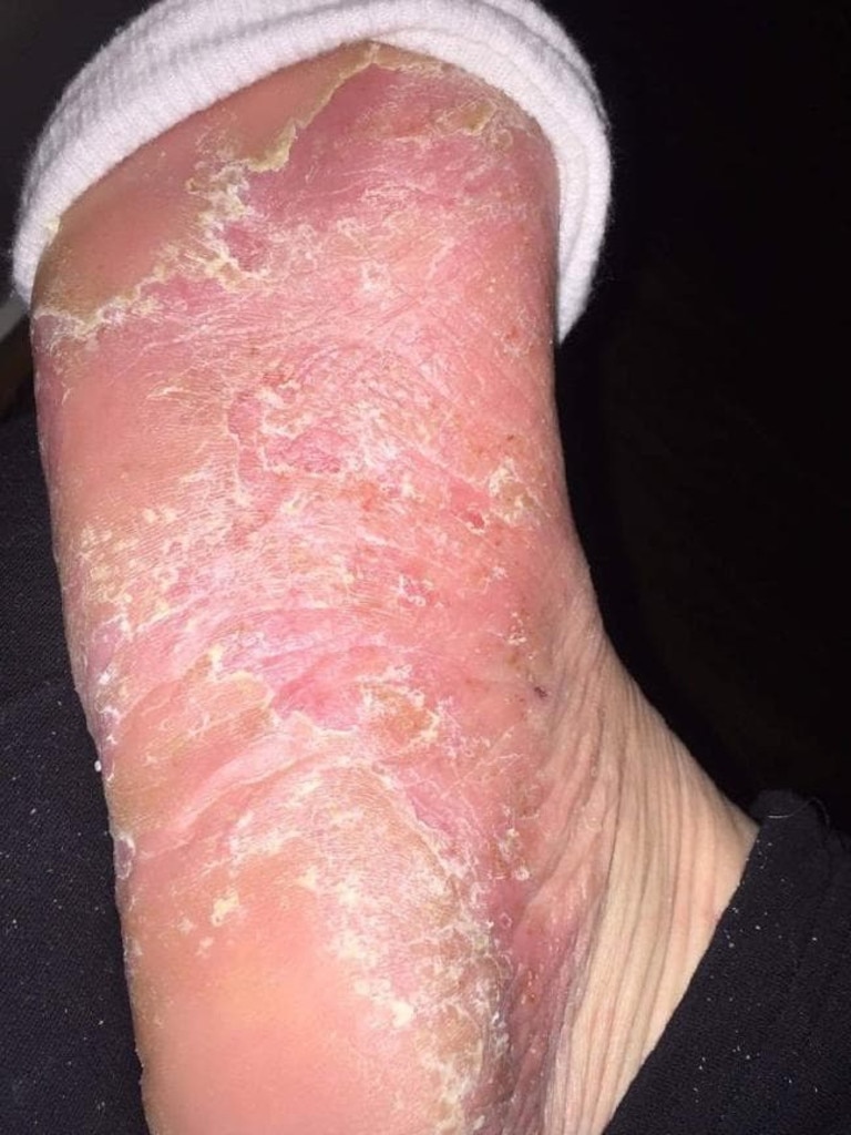 The mother of six has found her skin flared up the worst on her hands and feet. Picture: Supplied via NCA NewsWire