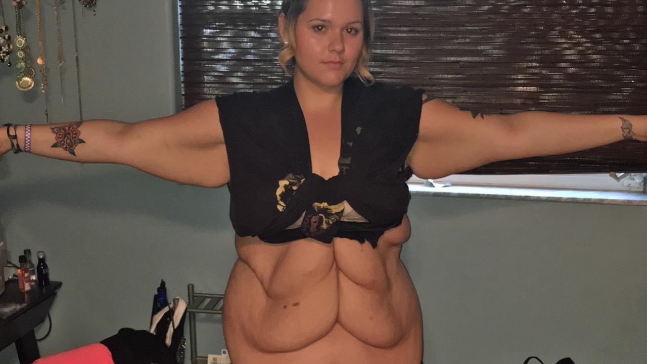 Weight Loss ‘what It’s Like To Have 12kg Of Excess Skin Removed’ Photos Herald Sun