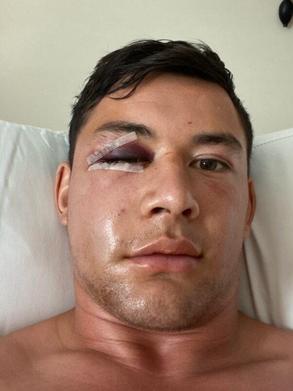 Joey Manu post surgery after having his cheekbone broken in a tackle by Latrell Mitchell.