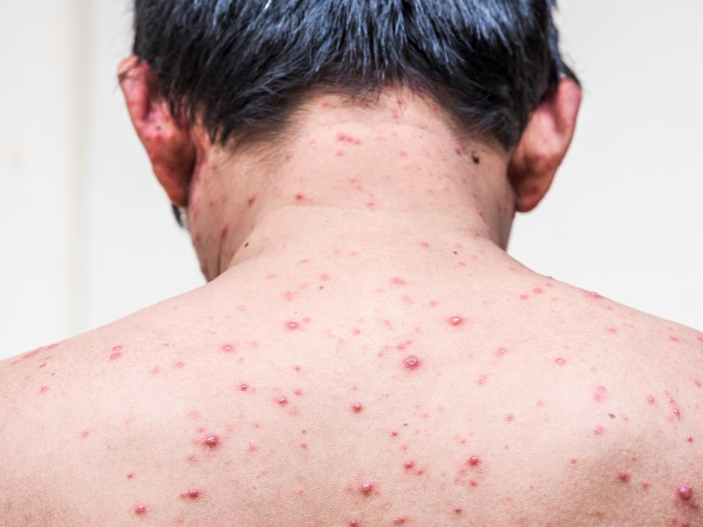 Chickenpox numbers are on the rise in Central Queensland