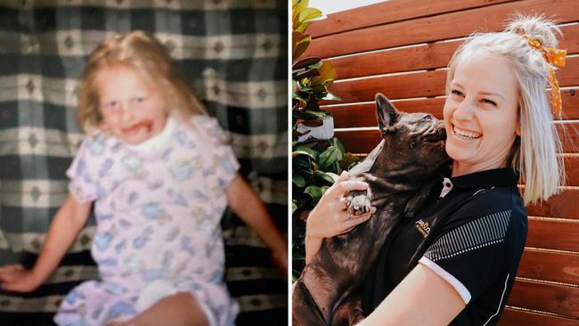 Left: Emily Middleton after was bitten by a dog when she was four. Right: Now, Ms Middleton she has created a business to try and help kids interact with animals.