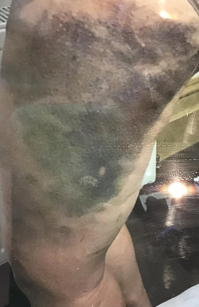 Severe bruising from Christine Annett's second accident. Picture: Supplied