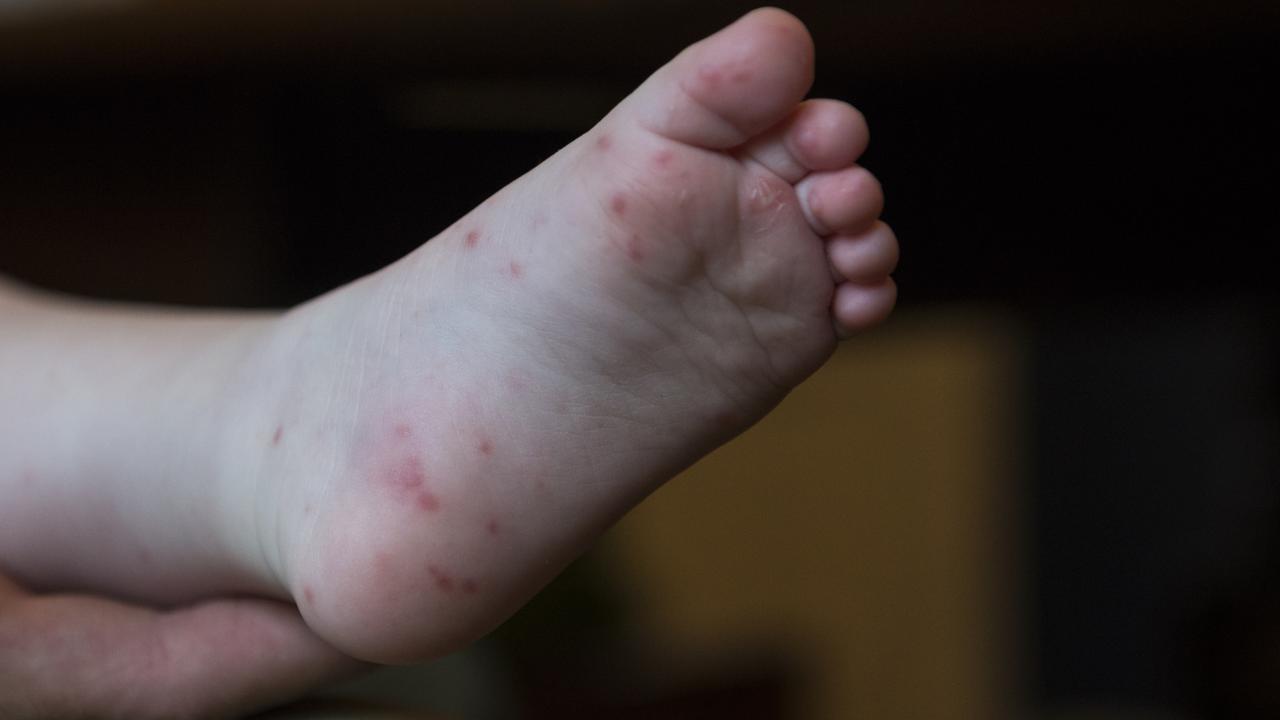 Hand foot mouth disease Cairns: Dozens of cases at FNQ day cares | The ...