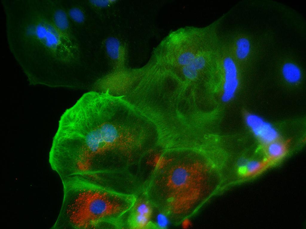 The placenta cells (in green) that are infected with the SARS-CoV-2 virus (Covid-19, in red). Picture: Supplied