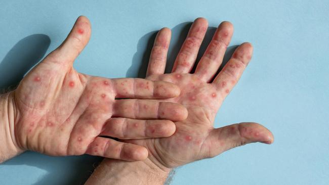 Mpox on a hand. Picture: Supplied