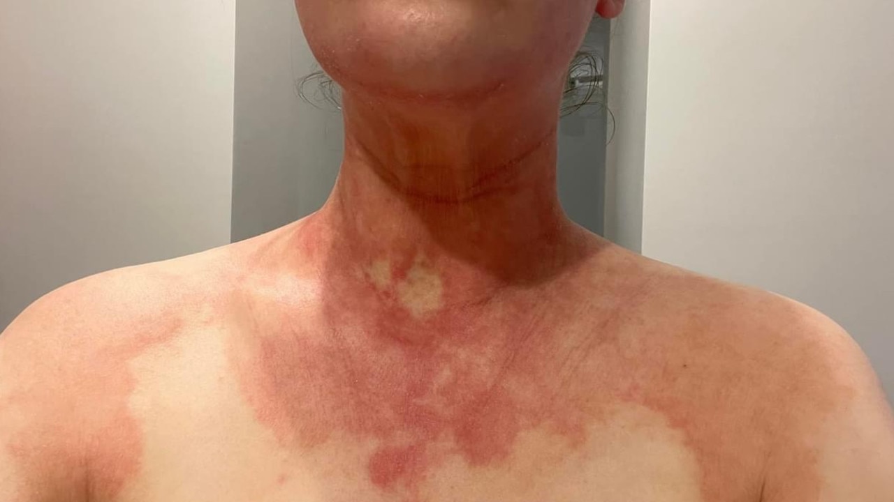 Rashes on Michelle Kate. Picture: Supplied