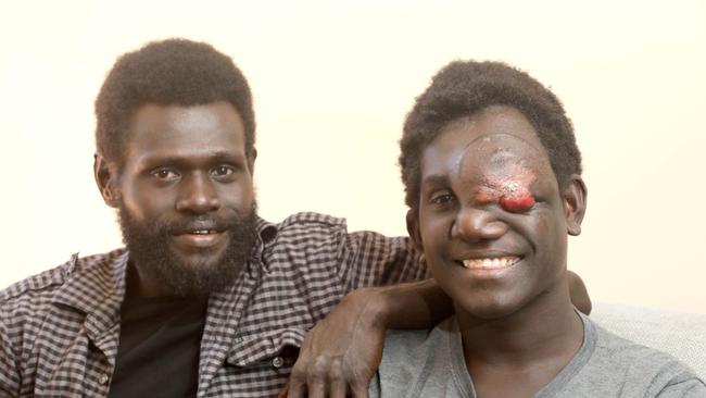 Isaac Oliver with his cousin, Victor Ramai, who was born with the tumour that cost him his left eye. Picture Dean Martin