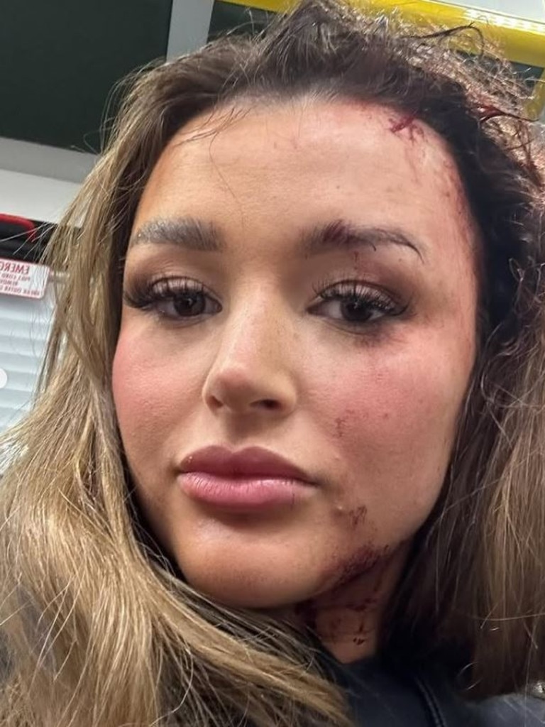 Ms Murphy following the attack. Picture: Instagram/charleenmurphy