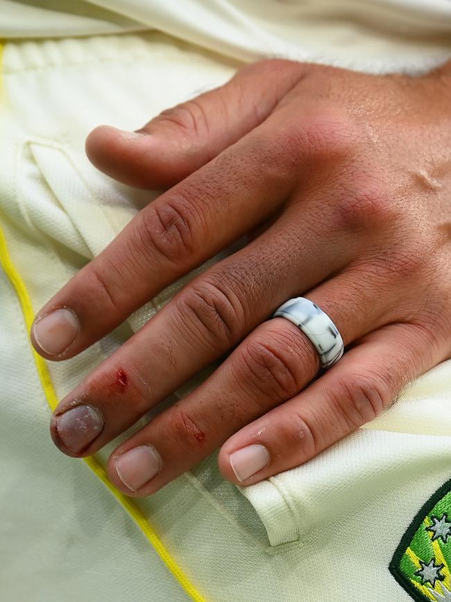 Mitchell Starc’s injured hand. Picture: Quinn Rooney/Getty