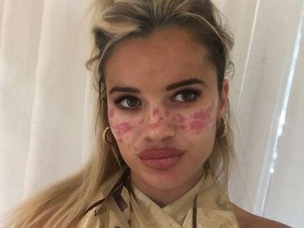 Big Brother star Tilly Whitfeld revealed her injured face.