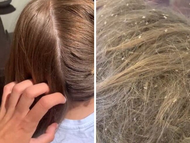 Video of girl's lice has stunned social media. Picture: @liceladyrachel