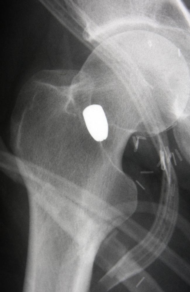 An X-ray of Lee Gordon-Brown’ right hip with an embedded projectile. Picture: Supplied