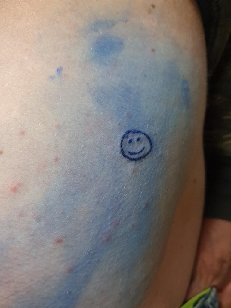 Benjamin Cations said he lost a bet. He lost a whole lot more really. His dignity. His job prospects. The chance to have a loving partner. It is supposed to a drunk smiley face but will always be tribute to another shit decision riding the Grog Monster. We bow to this tatt’s shit factor.