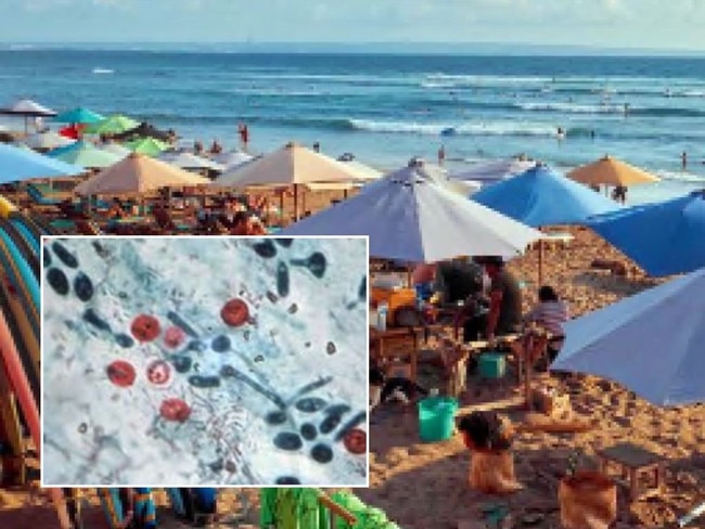 An outbreak of a gastro bug caused by a tiny parasite has been linked to overseas travel.