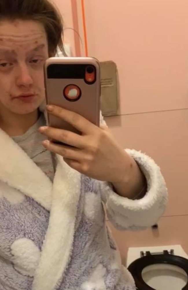 It left her looking gaunt, her skin to flare up with acne and her face to be covered in scabs. Picture: Facebook/Demi-Nicole Dunlop