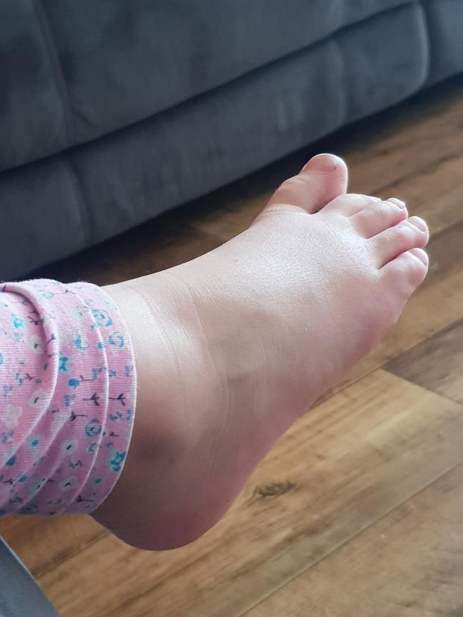 Sofia Allen’s feet and ankles swell as a result of her arthritis.