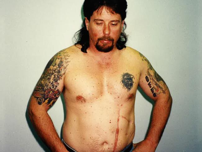 Sid Collins showing scars he received after being shot by Mark ‘Chopper’ Read.