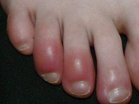 People with apparent chilblains might have COVID-19. Picture: Wikipedia.