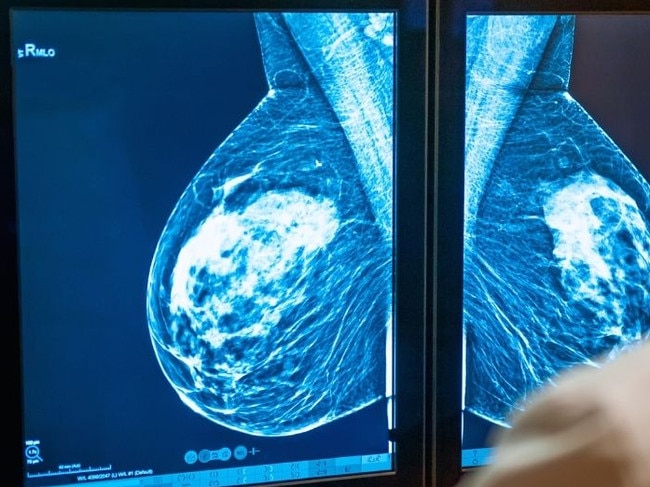 A mammogram can tell breast density.