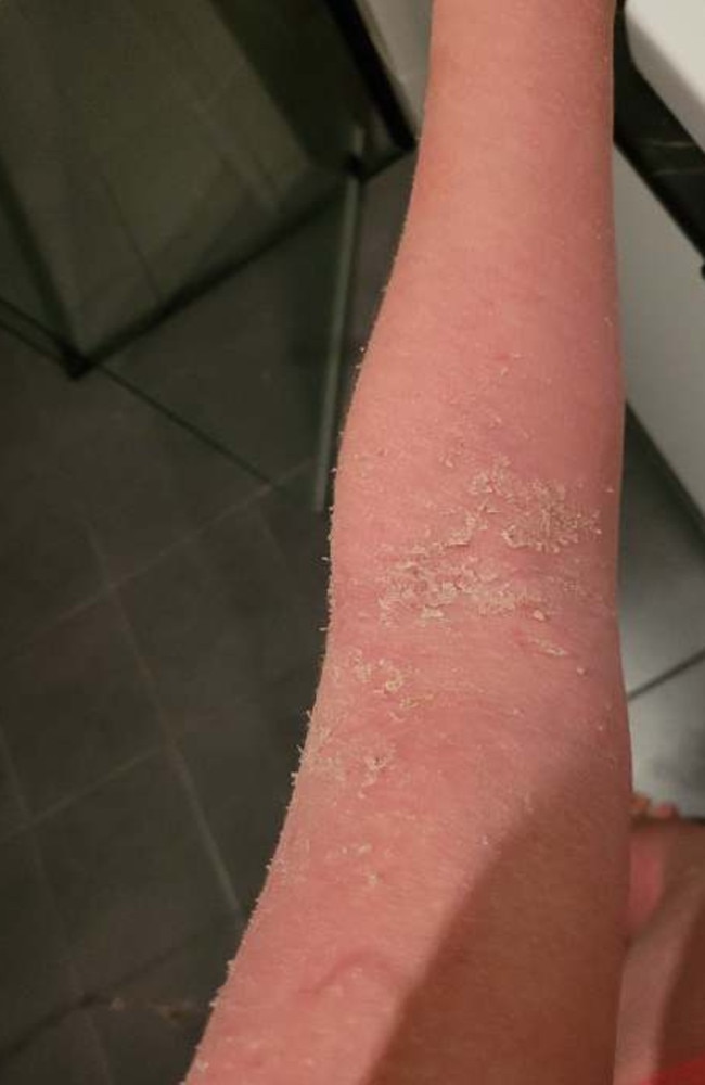 Kate Hodgkison's eczema. Picture: Supplied