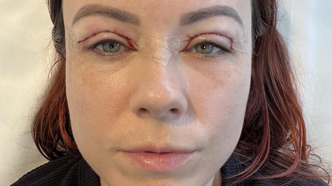 Blepharoplastyka: Dlaczego Blepharoplastyka staje się coraz bardziej popularna w Australii?