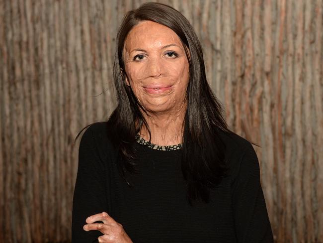 Multi-million settlement: Turia Pitt was burned on 60 per cent of her body while running an ultra-marathon.