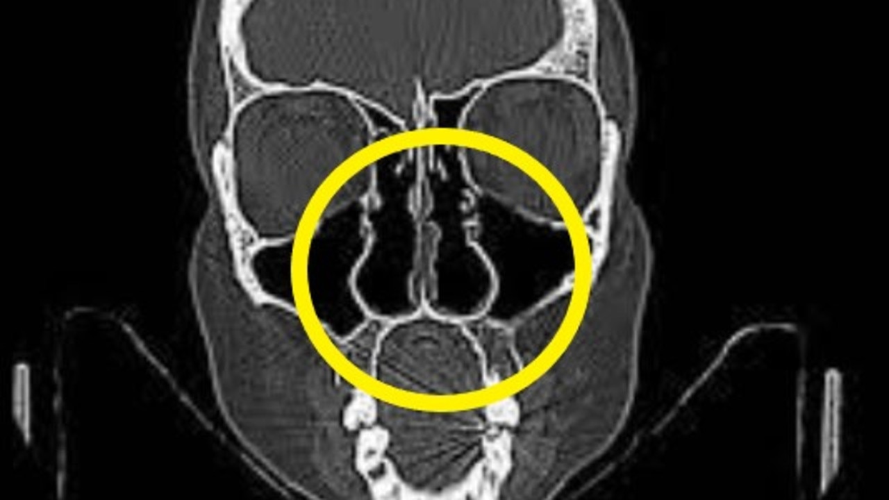 X-ray exposes horrific cause of suicide spate