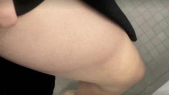 The photo of a bruise taken by Brittany Higgins. Picture: Seven News Spotlight