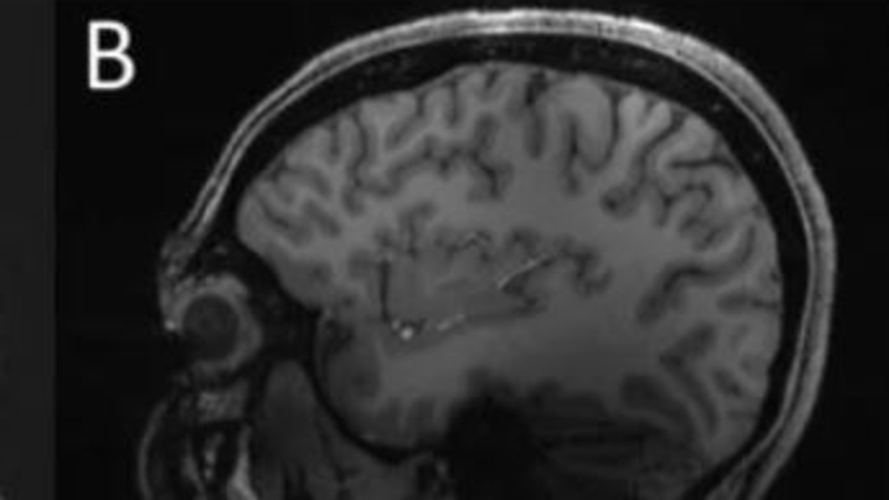 This image is a brain that doesn’t battle migraines. Picture: Radiological Society of North America