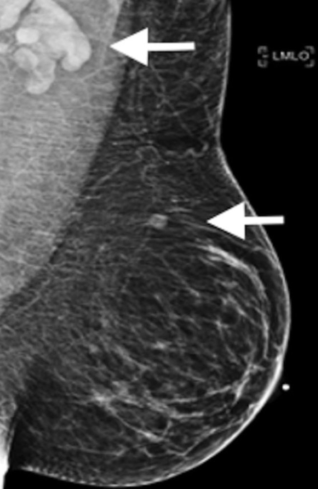 A woman’s inflamed lmph nodes after receiving the vaccination. Picture: Radiological Society of North America