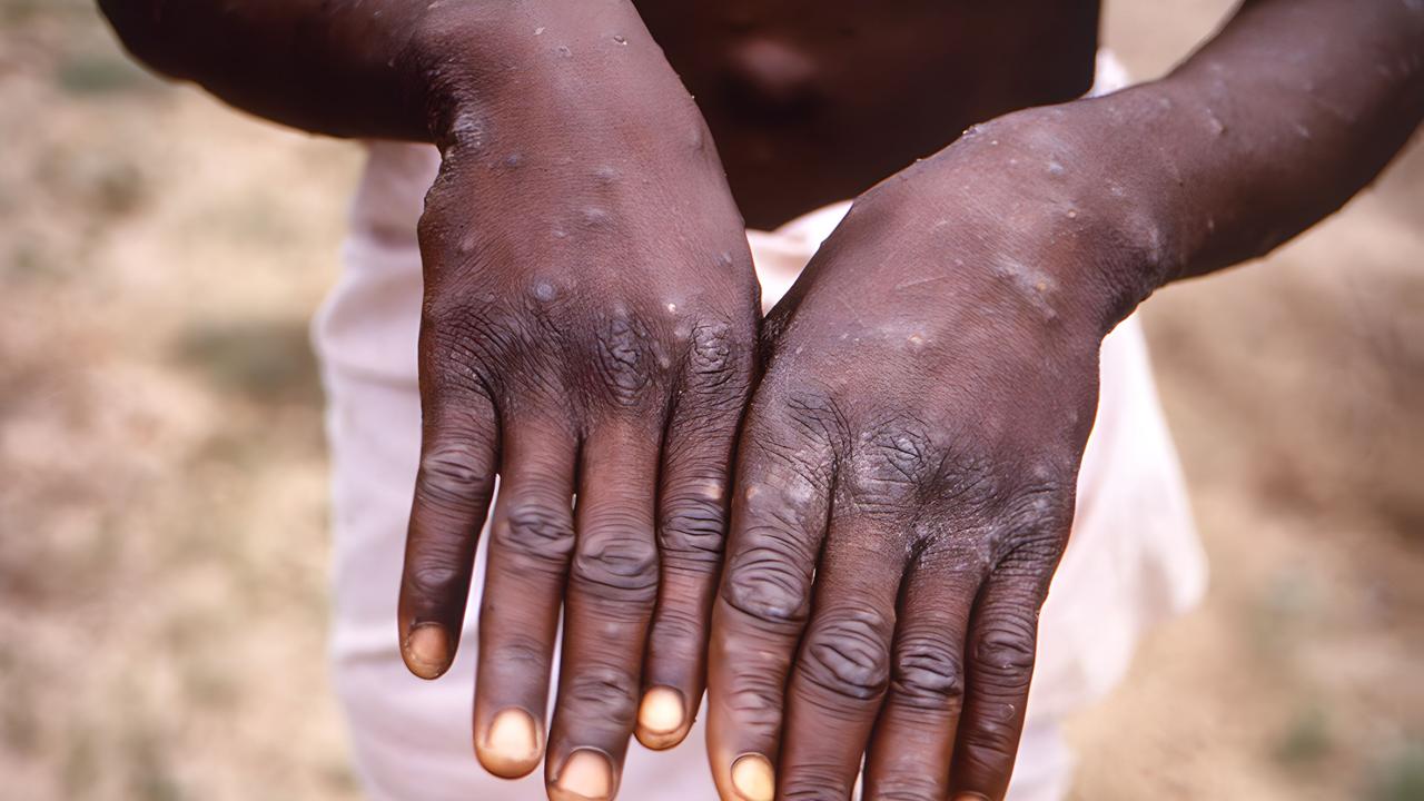 The characteristic rash during the recovery phase of mpox. Picture: CDC/IMAGE POINT FR/BSIP/Universal Images Group via Getty Images