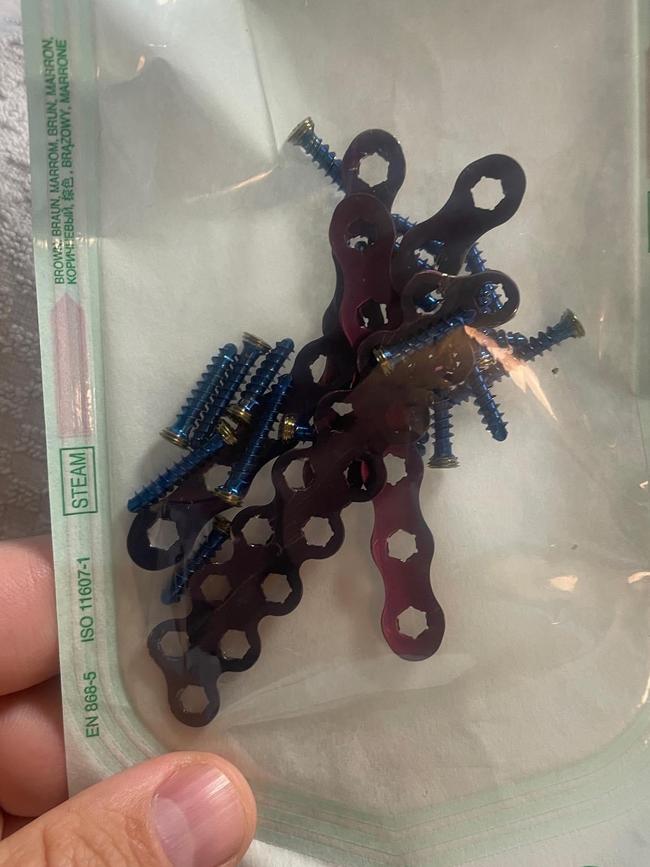 The screws and plates inserted into Matt Gilbertson’s foot. Picture: Matt Gilbertson