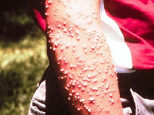 Pustules resulting from fire ant stings. Picture: University of Georgia