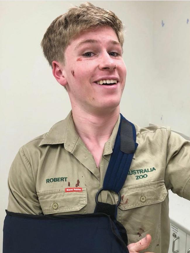 Robert Irwin has taken to social media to show off his injuries after he came off his mountain bike this morning.