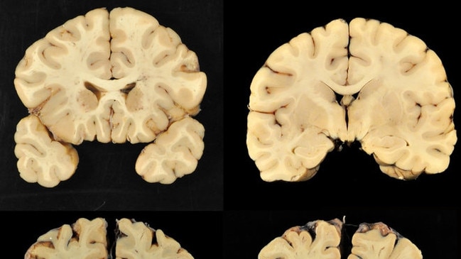 This combination of photos provided by Boston University shows sections from a normal brain, top, and from the brain of former University of Texas football player Greg Ploetz, bottom, in stage IV of chronic traumatic encephalopathy. According to a report released on Tuesday, July 25, 2017 by the Journal of the American Medical Association, research on the brains of 202 former football players has confirmed what many feared in life _ evidence of chronic traumatic encephalopathy, or CTE, a devastating disease in nearly all the samples, from athletes in the NFL, college and even high school. Picture:LiveScience