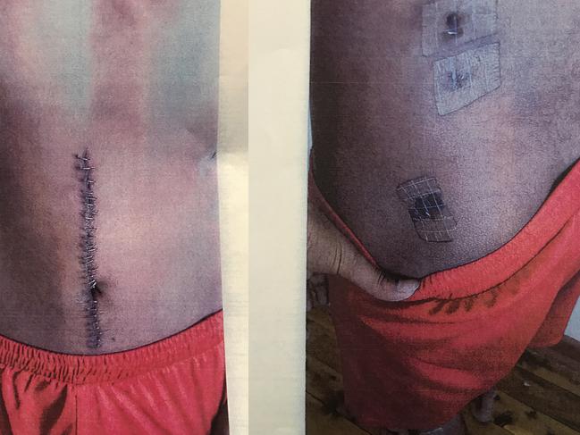 A composite of two photographs of evidenced supplied at the trail of Martin Hana, 25, at the NSW District Court. The images were taken by NSW Police on August 17, 2016, ten days after the 14-year-old boy pictured suffered nine penetrating knife wounds. Martin Hana, 25, has been jailed over the frenzied stabbing of a 14-year-old boy in western Sydney and will be eligible for parole from December 2020. (AAP Image/Sara McPhee) NO ARCHIVING