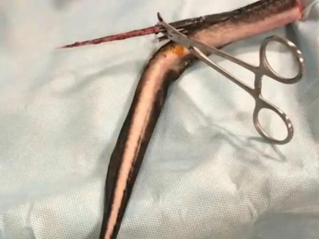 A woman trying to enjoy a relaxing afternoon in the ocean off Florida was impaled by a poisonous stingray whose barb came centimeters away from piercing her lungs.