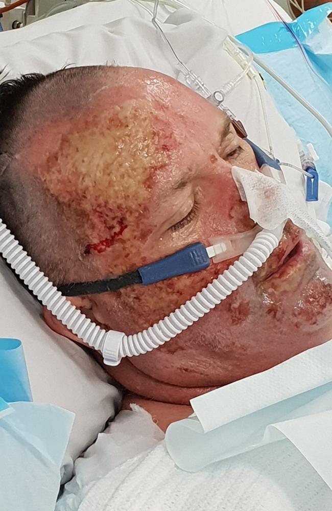 Darren Hopkins while he was recovering in the Royal Hobart Hospital after his plane crash. Picture: Supplied