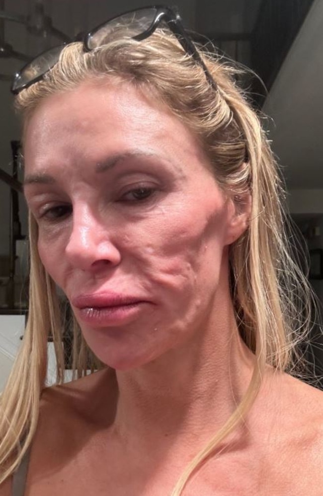 Brandi Glanville shared a photo of her facial disfigurement on X.